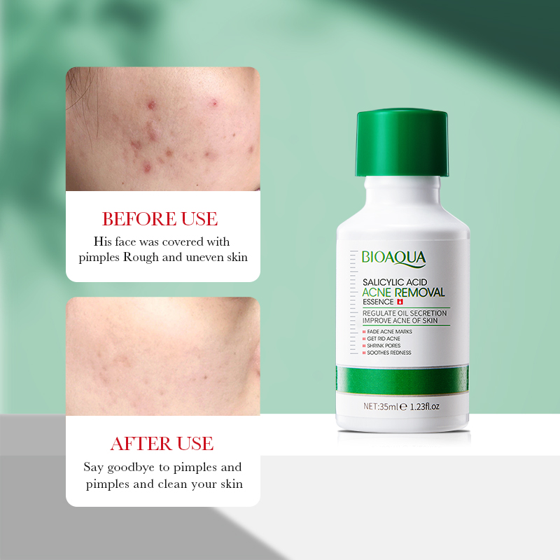 35ml BIOAOUA Salicylic Acid An - Salicylic Acid Blackhead Remover ulasan dan harga