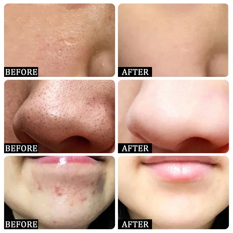Salicylic Acid Pore Clearing C - Salicylic Acid Blackhead Remover ulasan dan harga